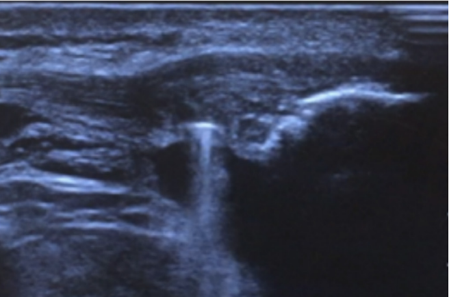 Lorenzo Masci (@lorenzo_masci) on Twitter photo 1/20 Excited to have my patellar tendon surgical paper accepted in <a href="/BMSM/">bamgra</a> open thank you to <a href="/HA/">ΨΨ³Ω πΈπ¦</a> <a href="/bradneal/">Brad Neal</a> Will Wynter Bee for your help. After years of data collection, reflection, writing, itβs finally published (yeah) but only as a report (sigh) bmjopensem.bmj.com/content/bmjoseβ¦ 1/20 Excited to have my patellar tendon surgical paper accepted in <a href="/BMSM/">bamgra</a> open thank you to <a href="/HA/">ΨΨ³Ω πΈπ¦</a> <a href="/bradneal/">Brad Neal</a> Will Wynter Bee for your help. After years of data collection, reflection, writing, itβs finally published (yeah) but only as a report (sigh) bmjopensem.bmj.com/content/bmjoseβ¦
