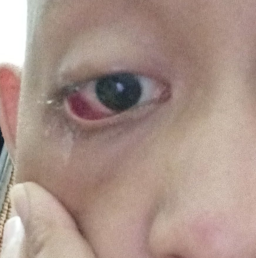 irdhalfadli's tweet photo. Kalazion adalah pembengkakan atau benjolan kecil yang muncul di kelopak mata akibat penyumbatan kelenjar meibom atau kelenjar minyak. Benjolan biasanya berukuran kecil sekitar 2-8 milimeter. 
Penanganan bisa dgn kompres air hangat, salep oles, tetes mata, dan konsumsi antibiotik. https://t.co/U12CSgoUod