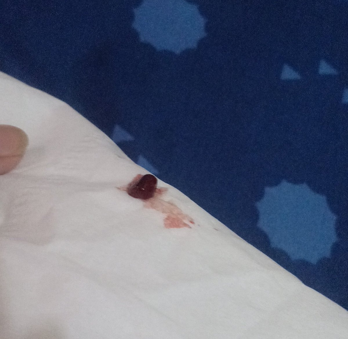 irdhalfadli's tweet photo. Kalazion adalah pembengkakan atau benjolan kecil yang muncul di kelopak mata akibat penyumbatan kelenjar meibom atau kelenjar minyak. Benjolan biasanya berukuran kecil sekitar 2-8 milimeter. 
Penanganan bisa dgn kompres air hangat, salep oles, tetes mata, dan konsumsi antibiotik. https://t.co/U12CSgoUod