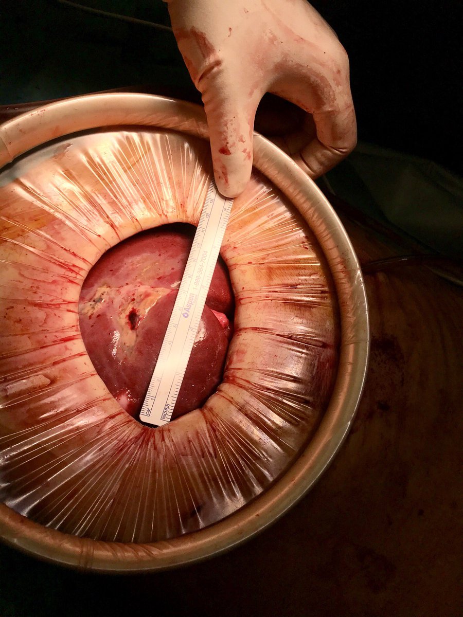 HondtMathieu's tweet photo. Major hepatectomy: lap mobilization, small 🔪,pringle through trocar incision =👌🏻exposure and pringle outside operative field
@sonalasthana @HPB_Txp_Surg @RSnyder_MD @VatcheAgopianMD @AlanHawxbyMD @JHawksworthMD @ElijahDixon7 @DenboJw @NirajGusani @tbeduschi @MarcBesselink https://t.co/wTRKvqWgBJ