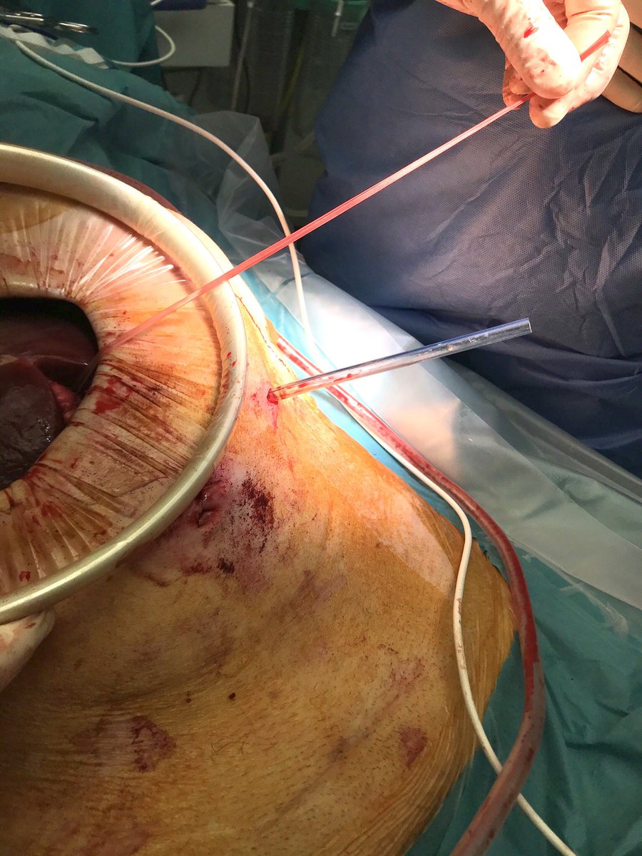 HondtMathieu's tweet photo. Major hepatectomy: lap mobilization, small 🔪,pringle through trocar incision =👌🏻exposure and pringle outside operative field
@sonalasthana @HPB_Txp_Surg @RSnyder_MD @VatcheAgopianMD @AlanHawxbyMD @JHawksworthMD @ElijahDixon7 @DenboJw @NirajGusani @tbeduschi @MarcBesselink https://t.co/wTRKvqWgBJ