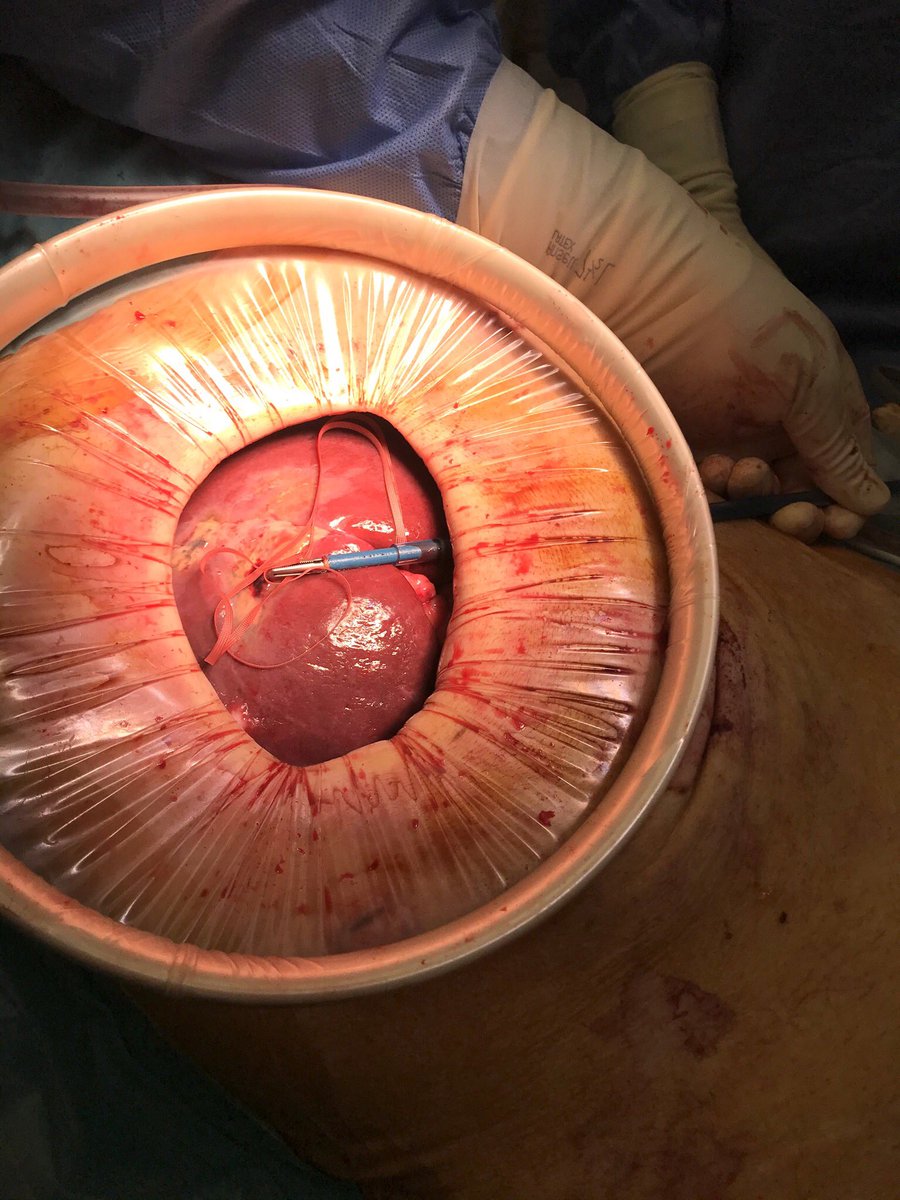 HondtMathieu's tweet photo. Major hepatectomy: lap mobilization, small 🔪,pringle through trocar incision =👌🏻exposure and pringle outside operative field
@sonalasthana @HPB_Txp_Surg @RSnyder_MD @VatcheAgopianMD @AlanHawxbyMD @JHawksworthMD @ElijahDixon7 @DenboJw @NirajGusani @tbeduschi @MarcBesselink https://t.co/wTRKvqWgBJ