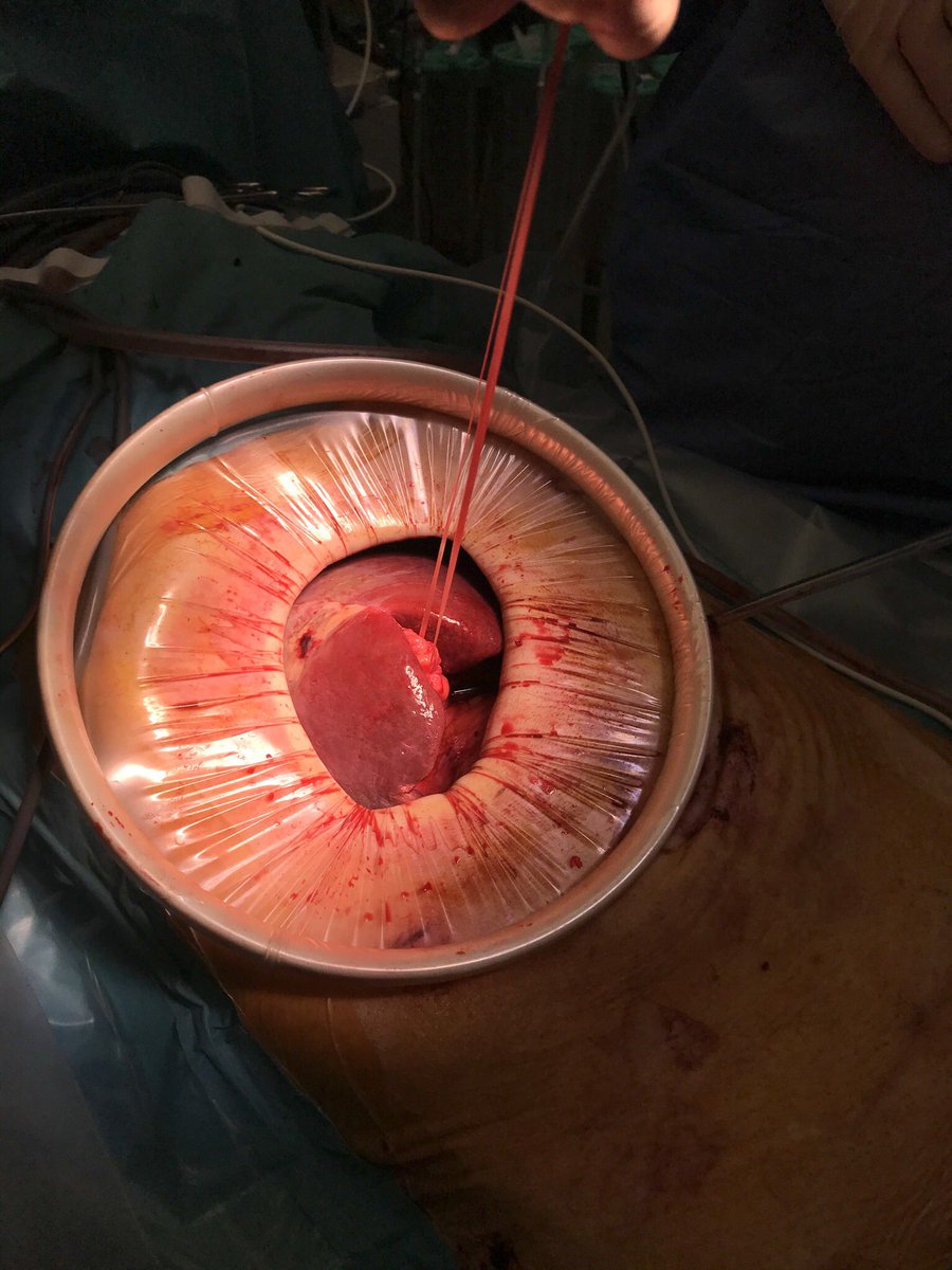HondtMathieu's tweet photo. Major hepatectomy: lap mobilization, small 🔪,pringle through trocar incision =👌🏻exposure and pringle outside operative field
@sonalasthana @HPB_Txp_Surg @RSnyder_MD @VatcheAgopianMD @AlanHawxbyMD @JHawksworthMD @ElijahDixon7 @DenboJw @NirajGusani @tbeduschi @MarcBesselink https://t.co/wTRKvqWgBJ