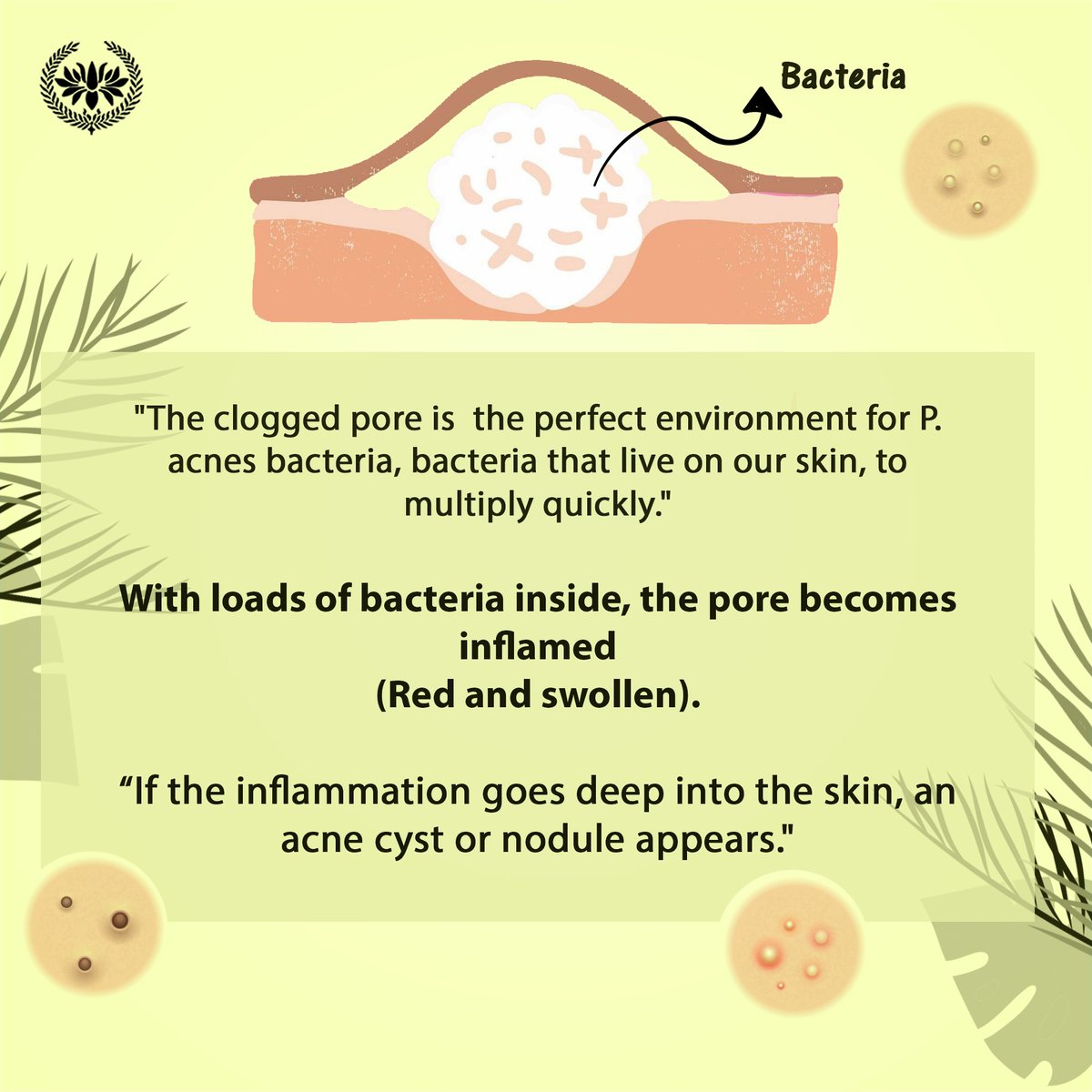 seersecrets's tweet photo. What causes #acne?

#seersecrets #yourbeautysecrets #acneawarenessweek #acnetreatment #acneprone #acneproneskin #adultacne #skincare #skin #skincareroutine #acnepositivity #acne #acneproducts #adultacne #cysticacne #skincaretips #skincareregime #skintherapist #skingoals #skinglow https://t.co/qm0t8onLmp