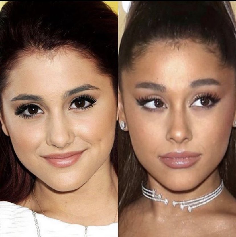 17- different shape now, like more “bone” was added. Her nose on the before photos is bulbous, her brows are lower, her lips smaller, her chin bigger. Not to mention her eyes are a different shape.