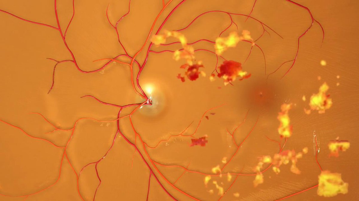 sight_nu's tweet image. ow.ly/X046102jhmb ow.ly/1GP3102jiEx Role of comorbidities in management of diabetic retinopathy - Optometry Times