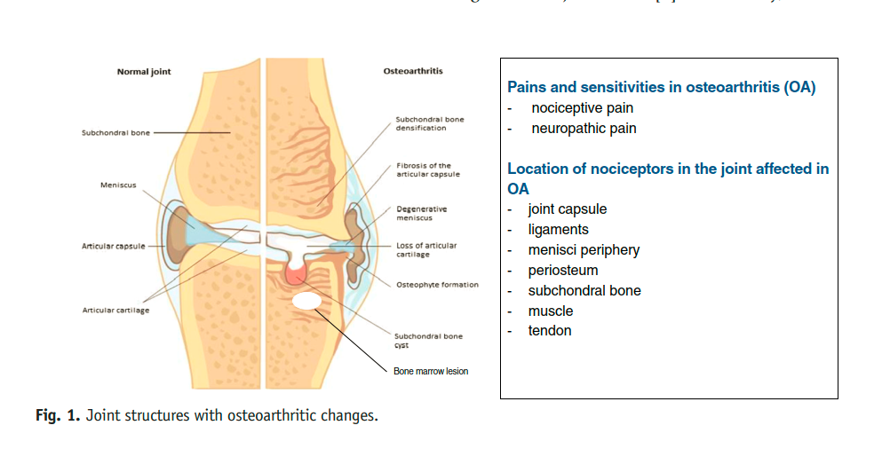 PhysioMeScience's tweet photo. Why Is Exercise Effective in Reducing Pain in People
with Osteoarthritis?

@STSkou @ewa_roos and colleagues

👀👇👇👇

https://t.co/BW81smEl2G https://t.co/BUqLBJKKNw