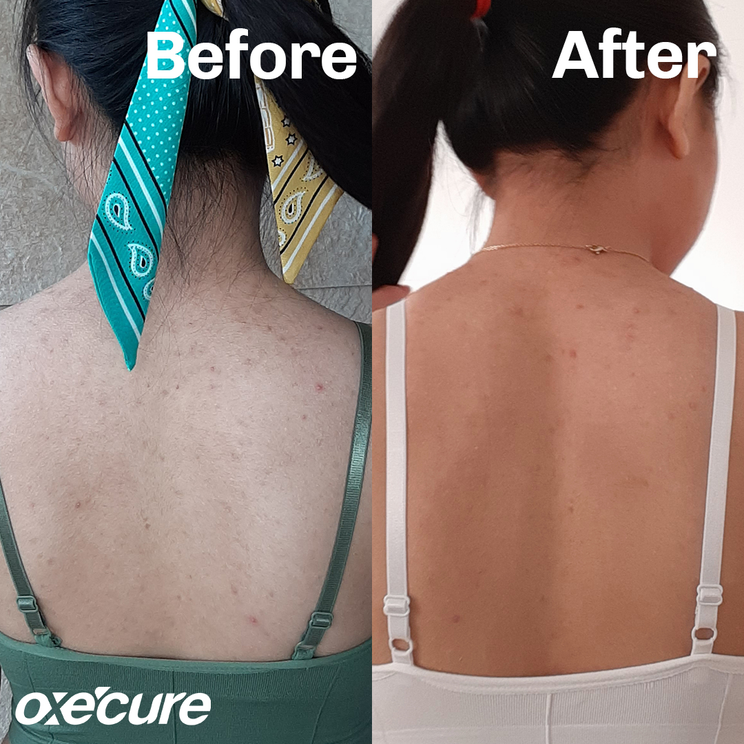 Oxecure_PH's tweet photo. According to Felicity, our Sulfur Soap and Body Acne Spray prove “that your [body] skincare CAN be effortless and effective at the same time!” 💚 Get our Body Starter Kit (P489) today and say goodbye to body acne! #OxecureStories #SkinUnfiltered https://t.co/5faJ29eGLB