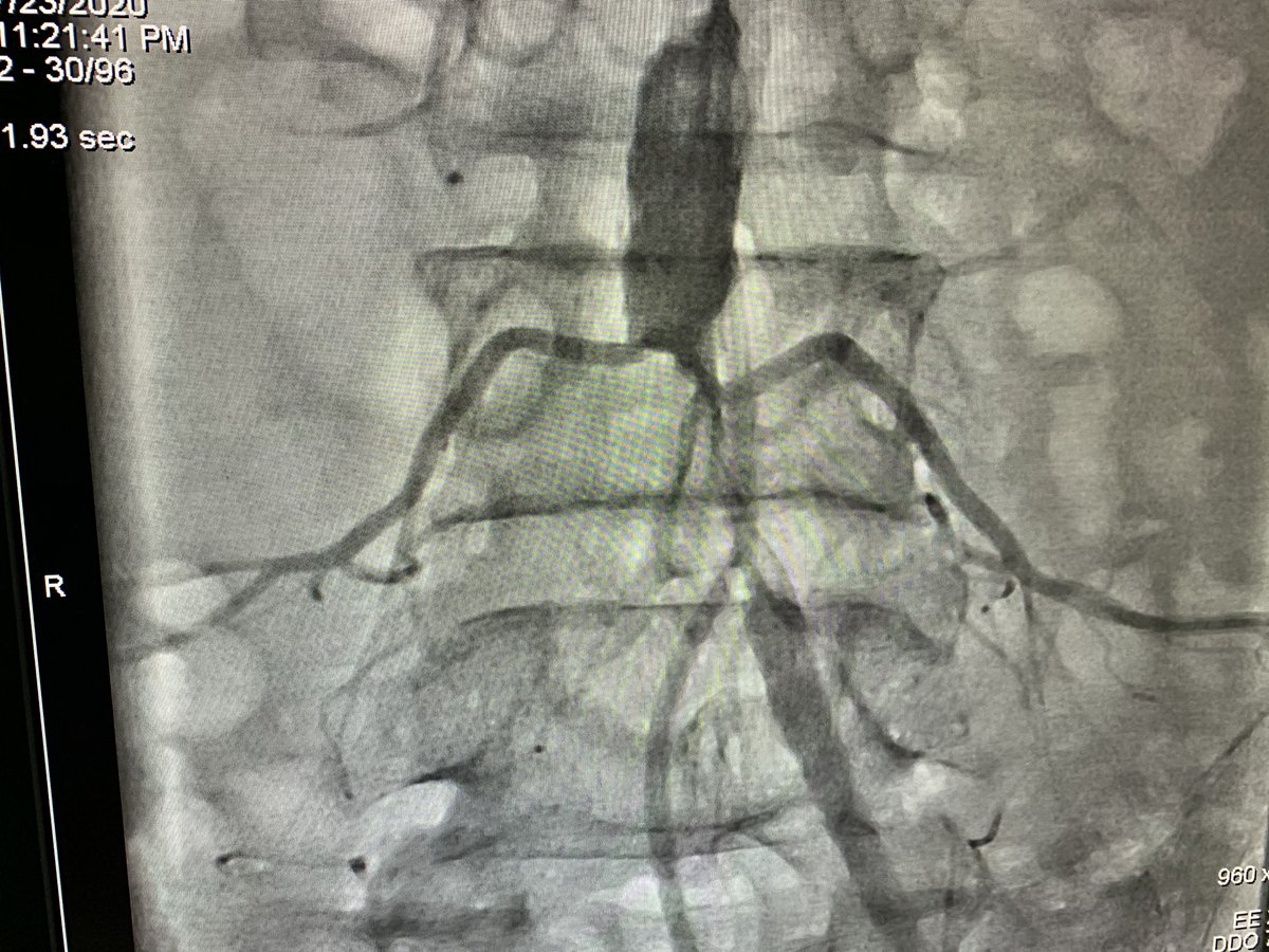 sajannarayanan's tweet photo. 67 yr old gentleman . Sudden onset weakness of both LL .. absent LL pulses .. left radial access ( higher puncture) . Intraarterial Tx with rPA for 24 hours .. check angiogram 24 hrs later on right @PCRonline #RadialFirst @DLBHATTMD @SVRaoMD https://t.co/cj7AV6t4Kb