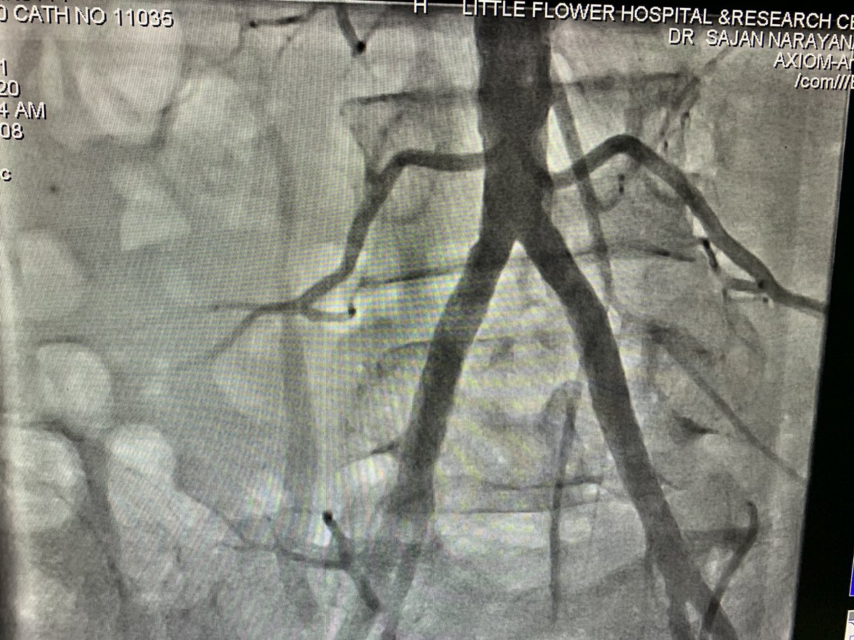 sajannarayanan's tweet photo. 67 yr old gentleman . Sudden onset weakness of both LL .. absent LL pulses .. left radial access ( higher puncture) . Intraarterial Tx with rPA for 24 hours .. check angiogram 24 hrs later on right @PCRonline #RadialFirst @DLBHATTMD @SVRaoMD https://t.co/cj7AV6t4Kb