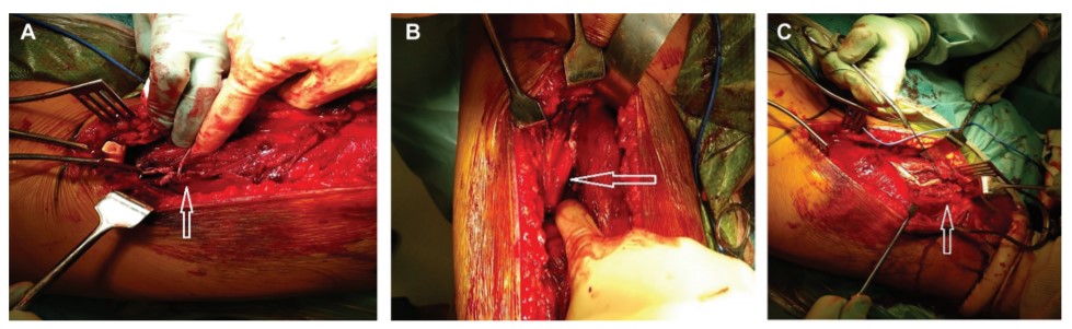 aossmjournals's tweet photo. New study demonstrates surgery for #AcuteTears of the #MusculotendinousJunction of proximal lateral #Hamstring enables #ReturnToSport at the same preinjury level
https://t.co/9GohICDS8h https://t.co/NCfoCaEUxX