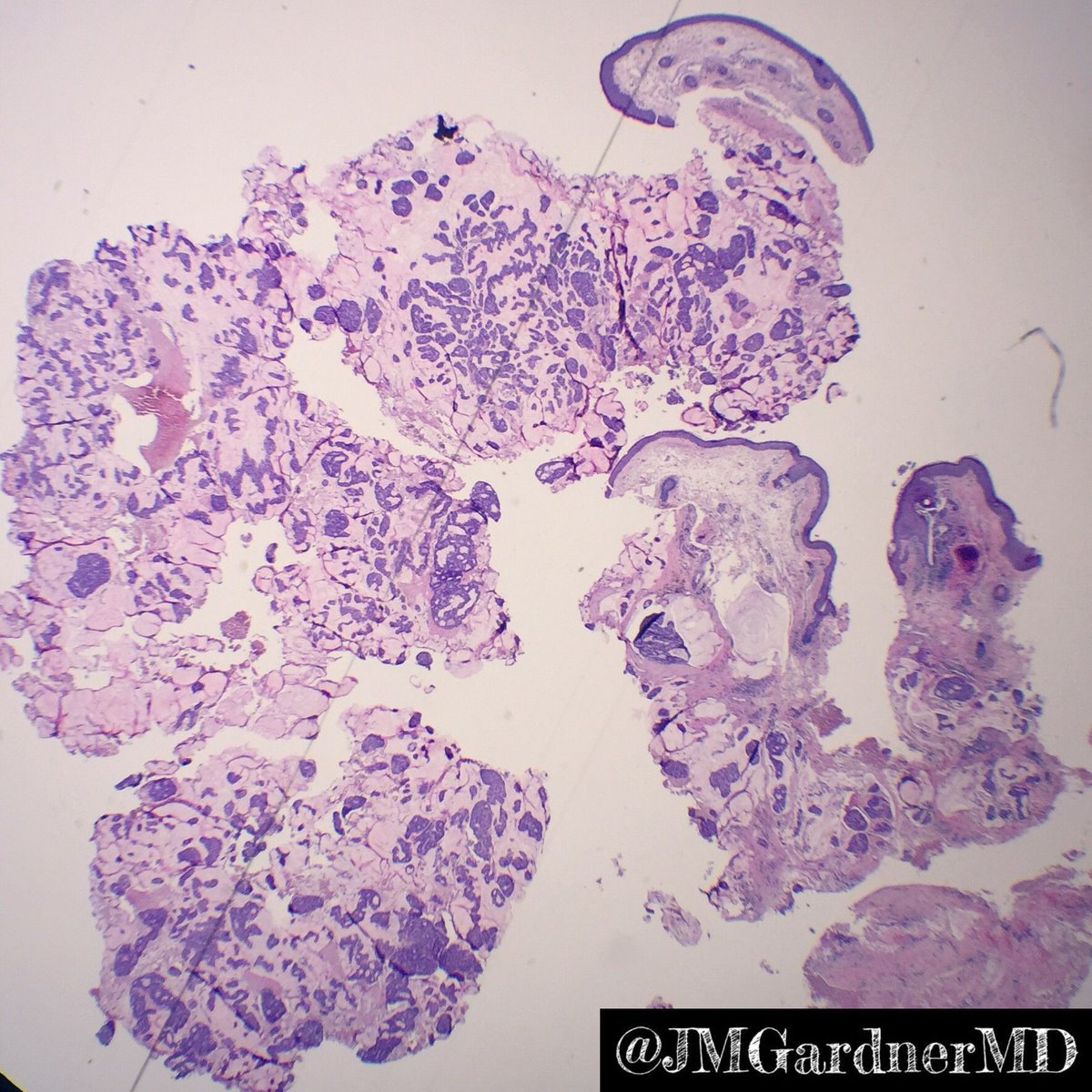 JMGardnerMD's tweet photo. Eyelid. Primary cutaneous mucinous carcinoma. Islands of basaloid cells in sea of mucin. Indolent. more info in my #dermpath #pathsurvivalguide book: https://t.co/85dyJi37nn #Pathology #dermpath #dermatology #dermatologia #dermtwitter https://t.co/mXqPaFjJxz
