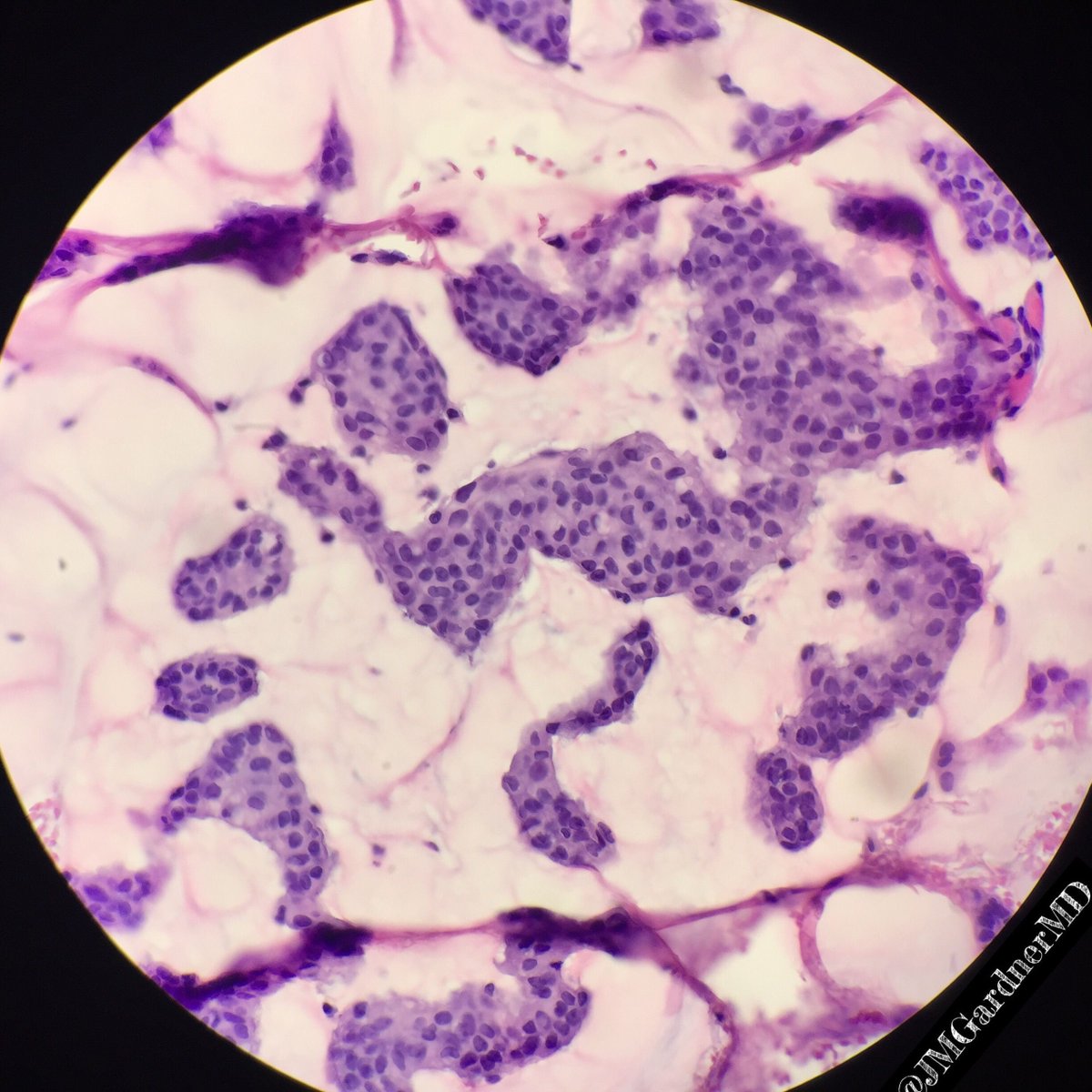 JMGardnerMD's tweet photo. Eyelid. Primary cutaneous mucinous carcinoma. Islands of basaloid cells in sea of mucin. Indolent. more info in my #dermpath #pathsurvivalguide book: https://t.co/85dyJi37nn #Pathology #dermpath #dermatology #dermatologia #dermtwitter https://t.co/mXqPaFjJxz