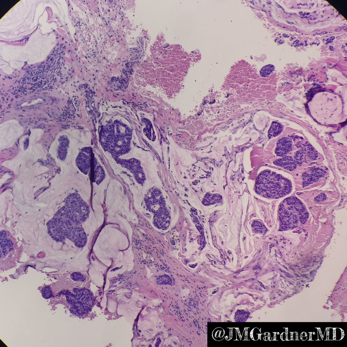 JMGardnerMD's tweet photo. Eyelid. Primary cutaneous mucinous carcinoma. Islands of basaloid cells in sea of mucin. Indolent. more info in my #dermpath #pathsurvivalguide book: https://t.co/85dyJi37nn #Pathology #dermpath #dermatology #dermatologia #dermtwitter https://t.co/mXqPaFjJxz