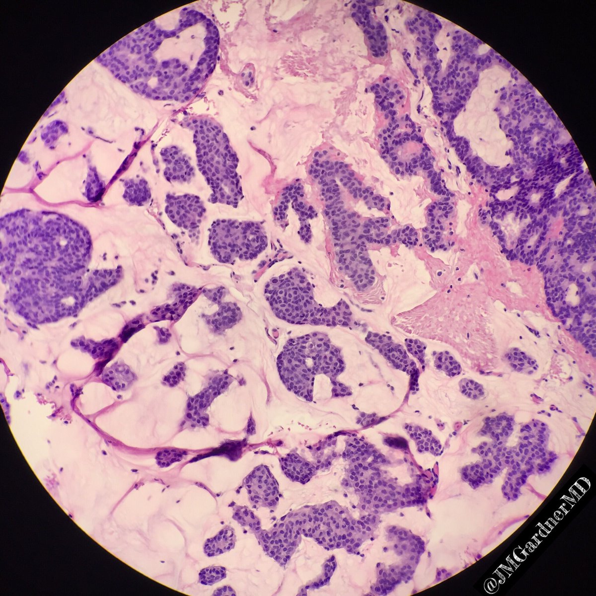 JMGardnerMD's tweet photo. Eyelid. Primary cutaneous mucinous carcinoma. Islands of basaloid cells in sea of mucin. Indolent. more info in my #dermpath #pathsurvivalguide book: https://t.co/85dyJi37nn #Pathology #dermpath #dermatology #dermatologia #dermtwitter https://t.co/mXqPaFjJxz