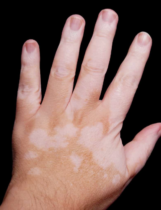 WHY AUTOIMMUNE CONDITIONS/THYROID PROBLEMS DISAPPEAR ON A CARNIVORE DIETI originally posted this a bit haphazardly as a response to a medical doctor being puzzled about the efficacy of the carnivore diet -- I would rather have it as my own threadTHREAD //