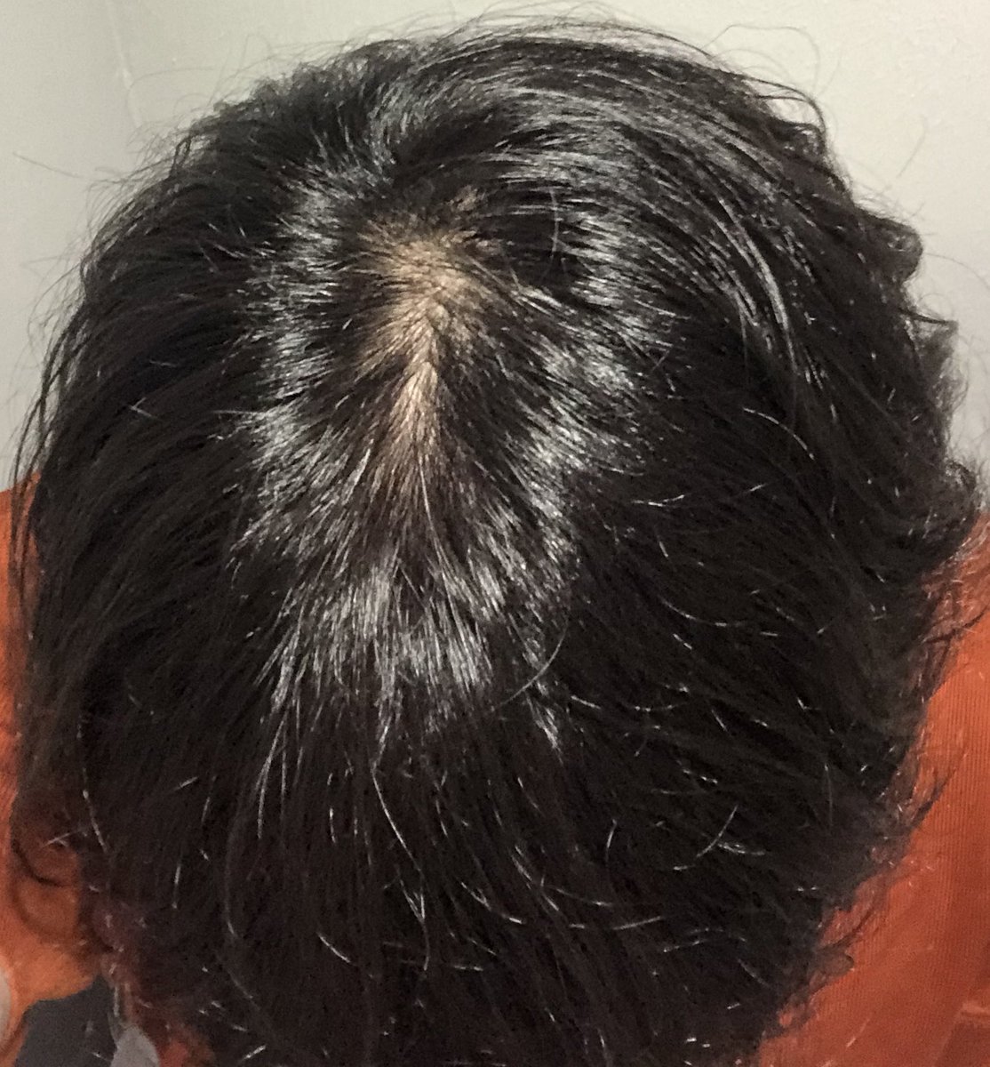 死に至る病 Aga治療 メンズ脱毛 つむじ薄いけど分けなかったらハゲってバレないくらいには埋まった あとは脱毛で体毛薄くしなきゃな