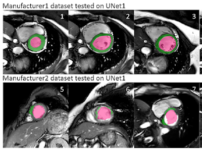 Radiology_AI's tweet photo. #DeepLearning segmentation can be made more generalizable by aggregating annotated training data from different manufacturers https://t.co/xubwpQWM3O @DrQtao #adaptableAI #AI #RadAI https://t.co/vGGIV0SWmn