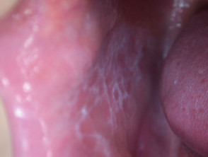 You can also make out white and gray lacy streaks and puncta. This is called "Wickham Striae" which helps confirm the diagnosis (1).Notably, LP also can go to the oropharynx, which can cause erosive lesions that are painful. Wickham Striae are easier to see in the mouth (2).3/