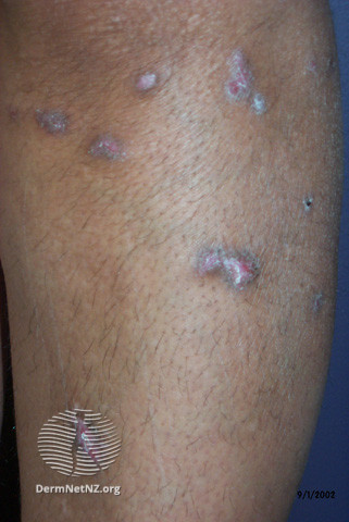 Remember that all inflammatory skin conditions can appear different in skin of color. LP tends to affect POC more, so this is critical!In pic 1, we see hypertrophic LP on darker skin on the shin. Notice that the erythema is much more muted when compared with whiter skin (2).4/