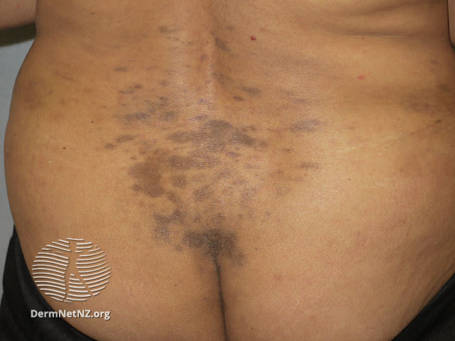 Finally, one more subtype to discuss. Lichen planus pigmentosus is a form of dyspigmentation that commonly affects the face (but can involve the torso & extremities). It can be cosmetically distressing, & more commonly affects skin of color.This is really difficult to treat!6/