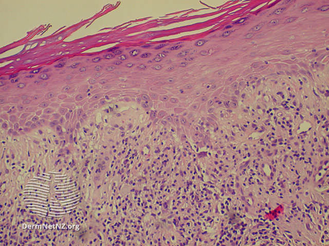 The path finding is the band-like lymphocytic infiltrate in the upper dermis. There are a lot of nuances to this with subtypes, but whenever we say "lichen," that's what we expect to see.Tagging our favorite  #dermpath  @ilanarosman if she feels compelled to add some detail9/