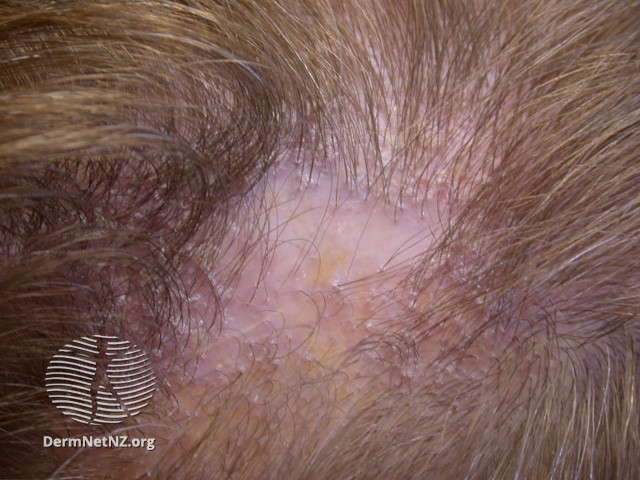A little more peripherally associated, lichen planopilaris is involvement of the scalp leading to a scarring alopecia. Classic findings include loss of follicular ostia, peri-follicular erythema & scaling.This can be associated with regular LP and a non-scarring alopecia!7/