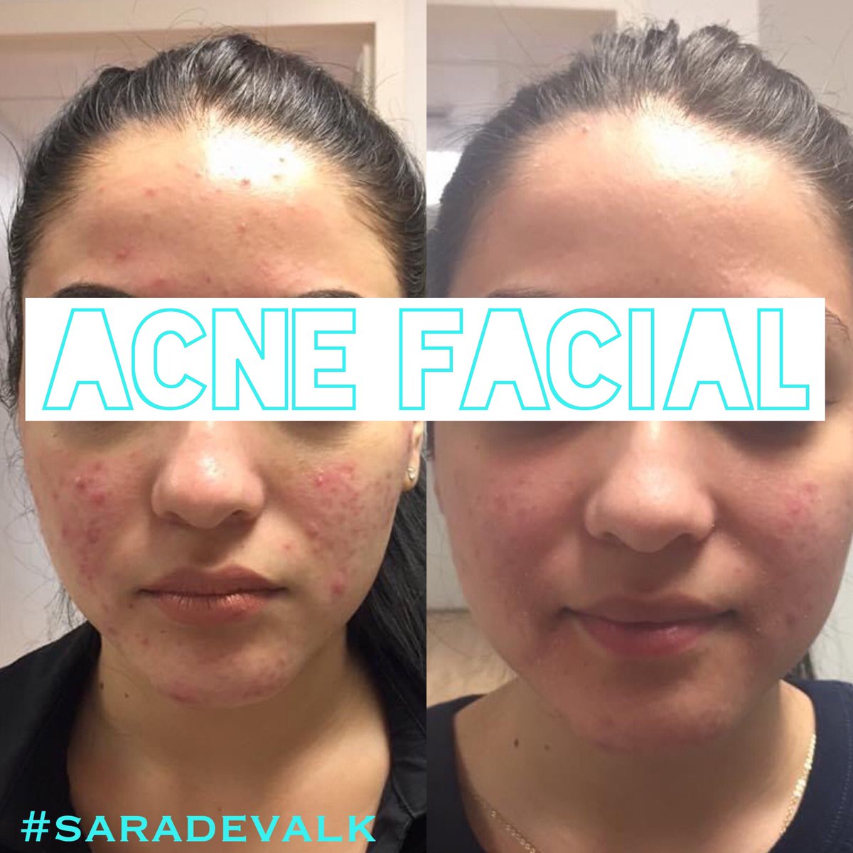 One week between photos , one treatment . #lifechangingresults #acnetreatment