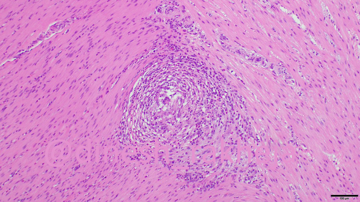 dinesh_rakheja's tweet photo. Solitary #granuloma in terminal ileum muscularis propria, overlying mucosa normal. What is that structure in the giant cell - disappears on deepers #Pathology @mreyesm @smlungpathguy @yro854 https://t.co/bRnoafEMRu