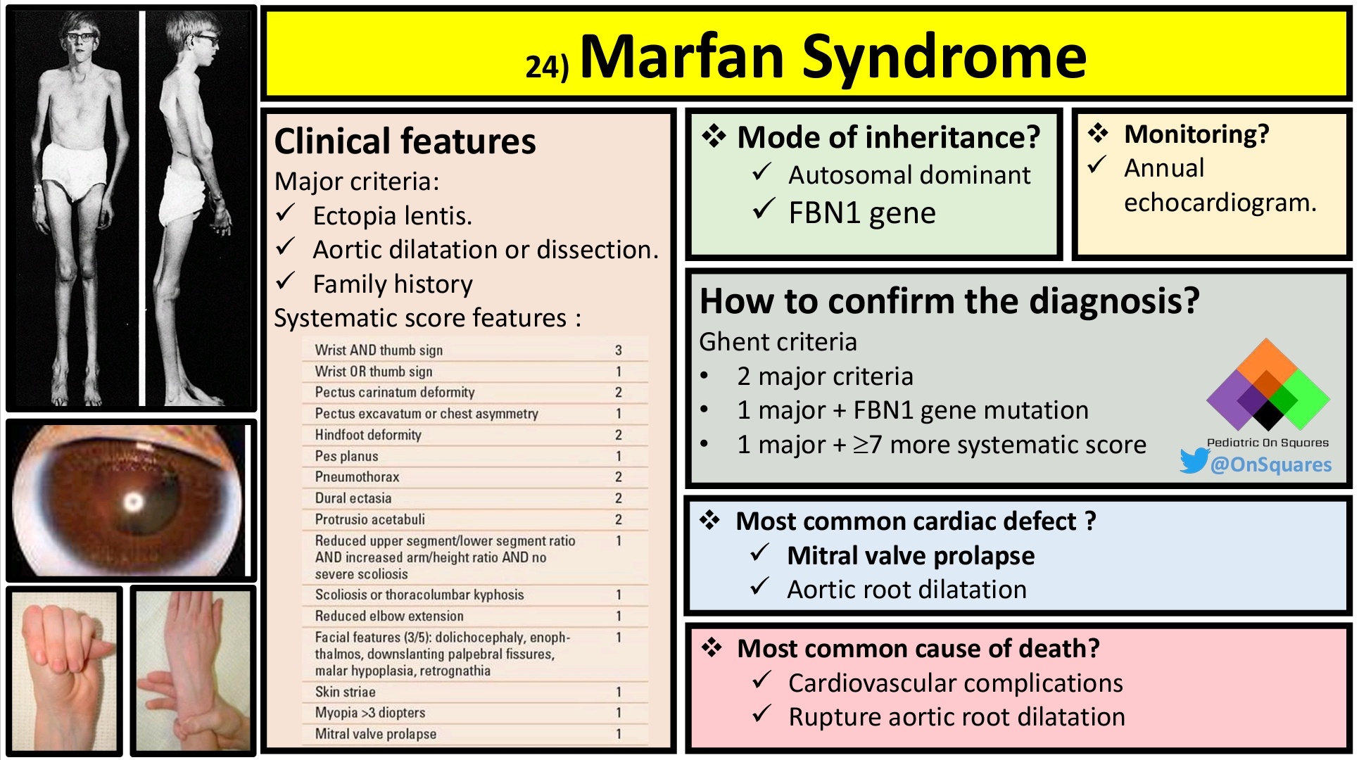 Pediatric On Squares On Twitter: "Summary Of Marfan Syndrome #Pediatric  #Genetics #Marfan Https://T.co/H1Biscq5Zm" / Twitter
