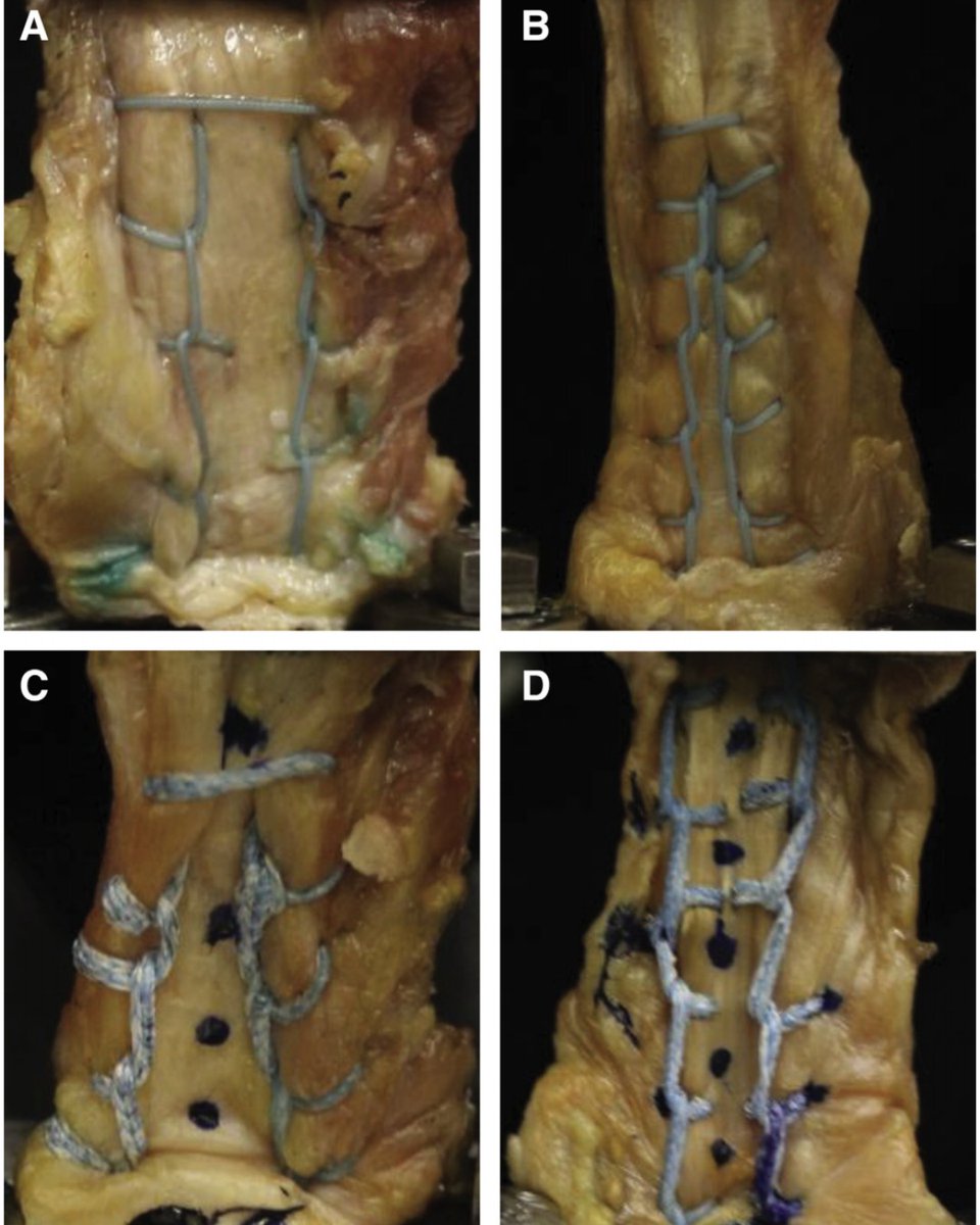 To tape or stitch that quads? A biomechanical study evaluating suture tape vs. high-strength suture repair of quadriceps tendon tears. arthroscopyjournal.org/article/S0749-… @FKSMC_Getgood <a href="/FKSMC_Degen/">Ryan Degen</a>