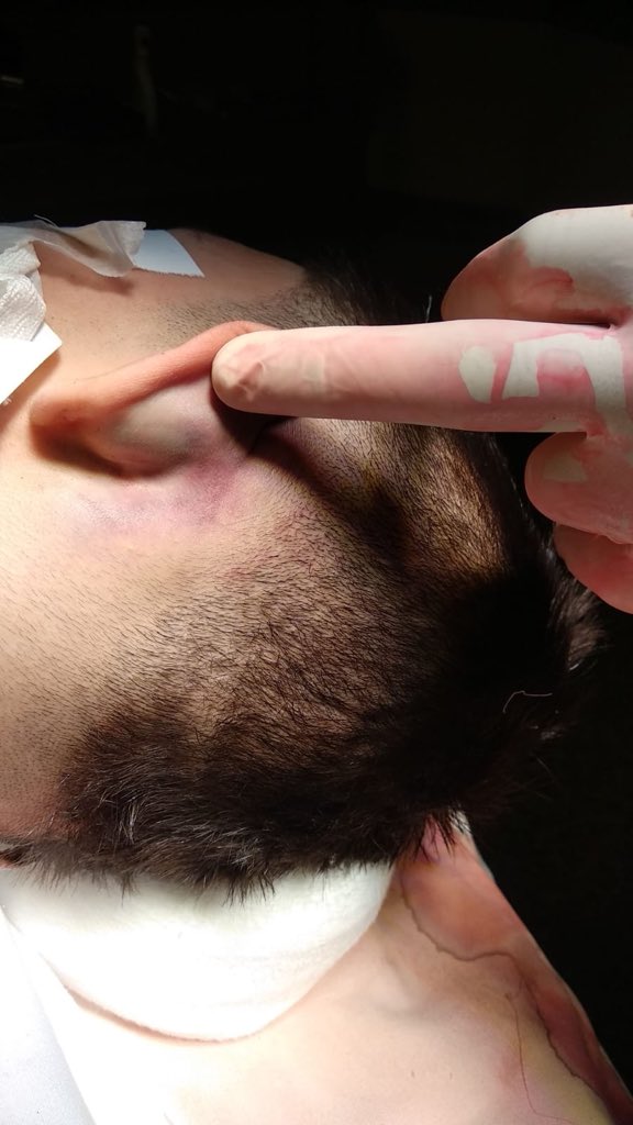 Hay signos clínicos típicos pero poco frecuentes, que nos hacen sospechar fracturas a nivel del cráneo. Los “ojos de mapache” nos hacen sospechar fractura del piso anterior, el “signo de Batlle” hace sospechar fractura de piso medio o en relación con la mastoides. Se ve así.