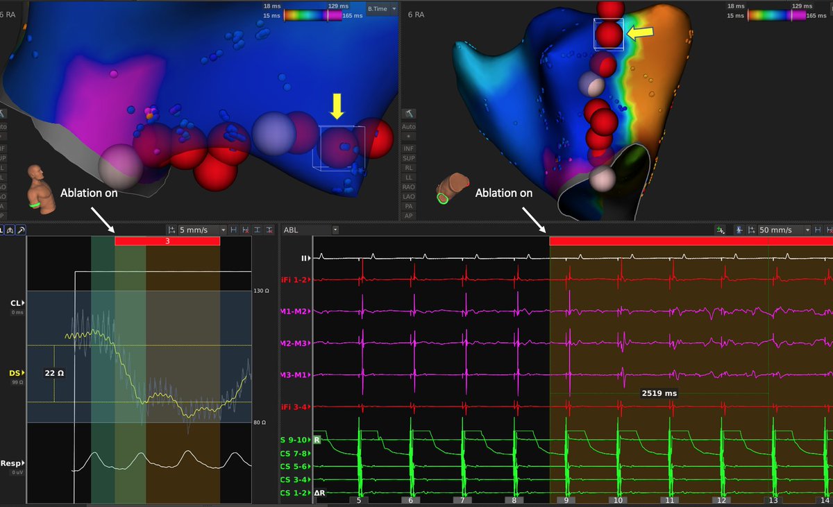 Henry D. Huang (@hhuang123) on Twitter photo Used DirectSense ablation catheter first time today. Nice to see the quick local impedance drop correlate with attenuation of EGMs on mini-electrodes in a thick area of tissue. Temporal tracking of impedance from catheter tip excellent. #EPeeps <a href="/krishmd/">Kousik Krishnan</a> <a href="/psharmadoc/">Parikshit S Sharma, MD, MPH, FACC, FHRS</a> <a href="/RushMedical/">Rush University System for Health</a> Used DirectSense ablation catheter first time today. Nice to see the quick local impedance drop correlate with attenuation of EGMs on mini-electrodes in a thick area of tissue. Temporal tracking of impedance from catheter tip excellent. #EPeeps <a href="/krishmd/">Kousik Krishnan</a> <a href="/psharmadoc/">Parikshit S Sharma, MD, MPH, FACC, FHRS</a> <a href="/RushMedical/">Rush University System for Health</a>