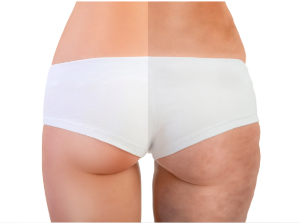 EPAT Cellulite Treatment!! Acoustic pressure waves are applied to the body to reverse and eliminate visible signs of connective tissue disorder which results in the appearance of cellulite. A series of treatments can remove cellulite, wrinkles and improve the tone and texture!