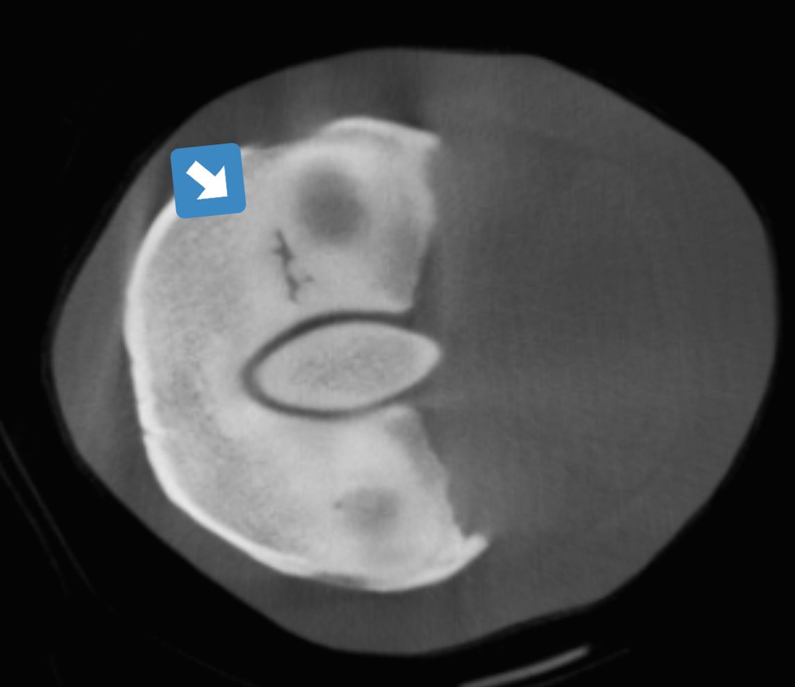 HoganEquine's tweet photo. Great example of preventative value of new imaging 👀 options used in collaboration in equine vet med-we sent this TB colt to @NewBoltonCenter for robot CT imaging and they found very rare early stress fx in pastern which we then repaired with single screw 🙌🏻#teamwork 🐎 https://t.co/Py8fi5iFzD