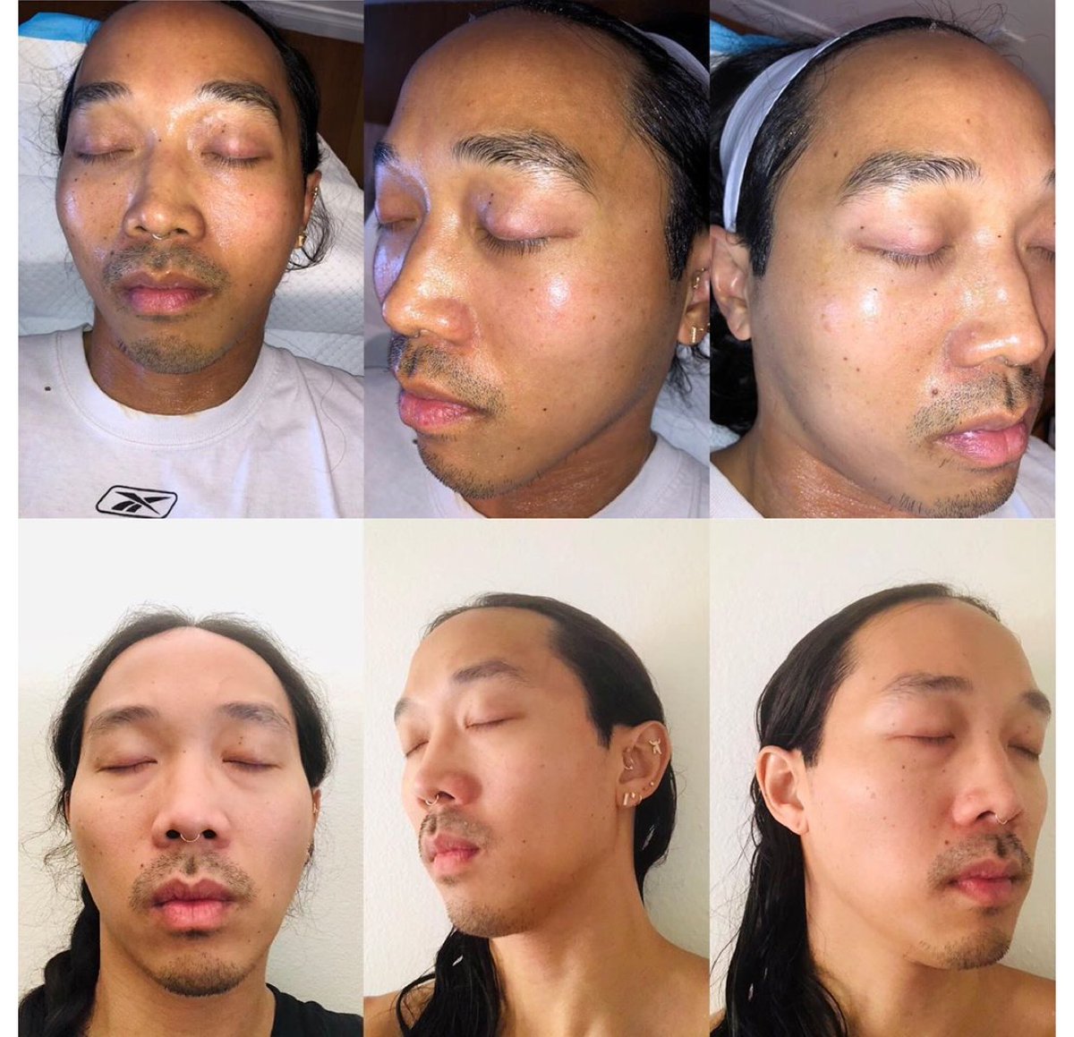 juventix's tweet photo. Final results of a  microneedling with procedure for men!

In this photo you can see the patient is 2 weeks post-procedure. The before photos can be seen at the top row, and the after photos can be seen at the bottom. 
Rejuvenated skin for this male beauty! 

#Juventix  #PRP https://t.co/prrrOE1iXx