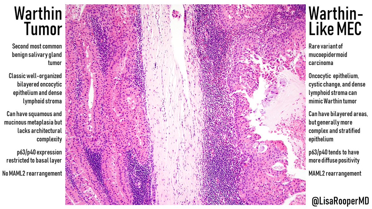 This Warthin-like mucoepidermoid carcinoma very conveniently arose next to a benign Warthin tumor, letting us compare their features side by side! Architecture is key for this differential, and MAML2 confirms the diagnosis. #ENTPath #OralPath #SurgPath