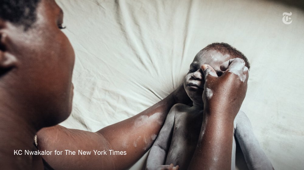 In Nigeria, rising temperatures are supercharged by nonstop gas flares that can singe the skin.Faith Osi, a mother of 8, says heat rash is a constant worry. Here she covers her youngest child, Miracle, with talcum powder to soothe the baby’s discomfort.