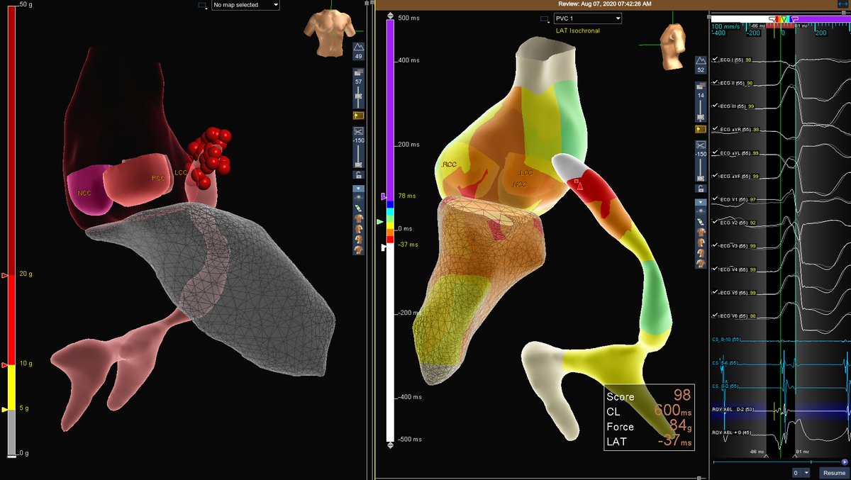 ClairePoindext2's tweet photo. Great AIV PVC case this morning using #HDGrid and #TactiCathSE with @RajeshVenkatar5 @AbbottCardio https://t.co/sdsIdhXU4Q