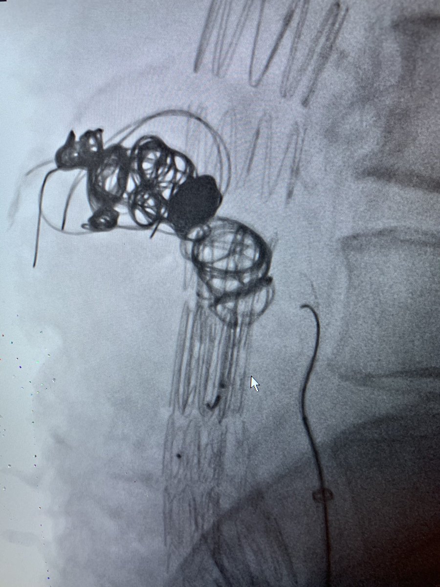 TriHealthVasc's tweet photo. We’ve been busy the last two weeks!
- Explant infected EVAR with cryogenic allograft recon
- Explant infected aortobi-iliac with aortoenteric fistula
- 1 ABF
- 4 CEAs
- 4 EVARs, one with the Bolton Treo (first approved case in OH)
- Transcaval type II endoleak embolization https://t.co/US8J120d6C