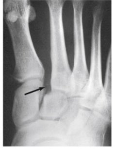fundamentalofSM's tweet photo. Any idea as to what this X-ray is demonstrating?! Let us know in the comments below! #FSM #learning #foot #6pmsquad #thursdayvibes https://t.co/hrHbtwlnvo