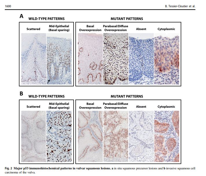 tl/dr: p53 immunostain in vulvar lesions can be quite challenging! This article is a great resource for interpretation!
pubmed.ncbi.nlm.nih.gov/32203095/

discovered with <a href="/orbitcme/">Orbit CME</a> for <a href="/pathologycast/">pathCast</a>. Earn SAM for this article at orbitcme.com/join/pathcast

#pathcast #pathology #gynpath