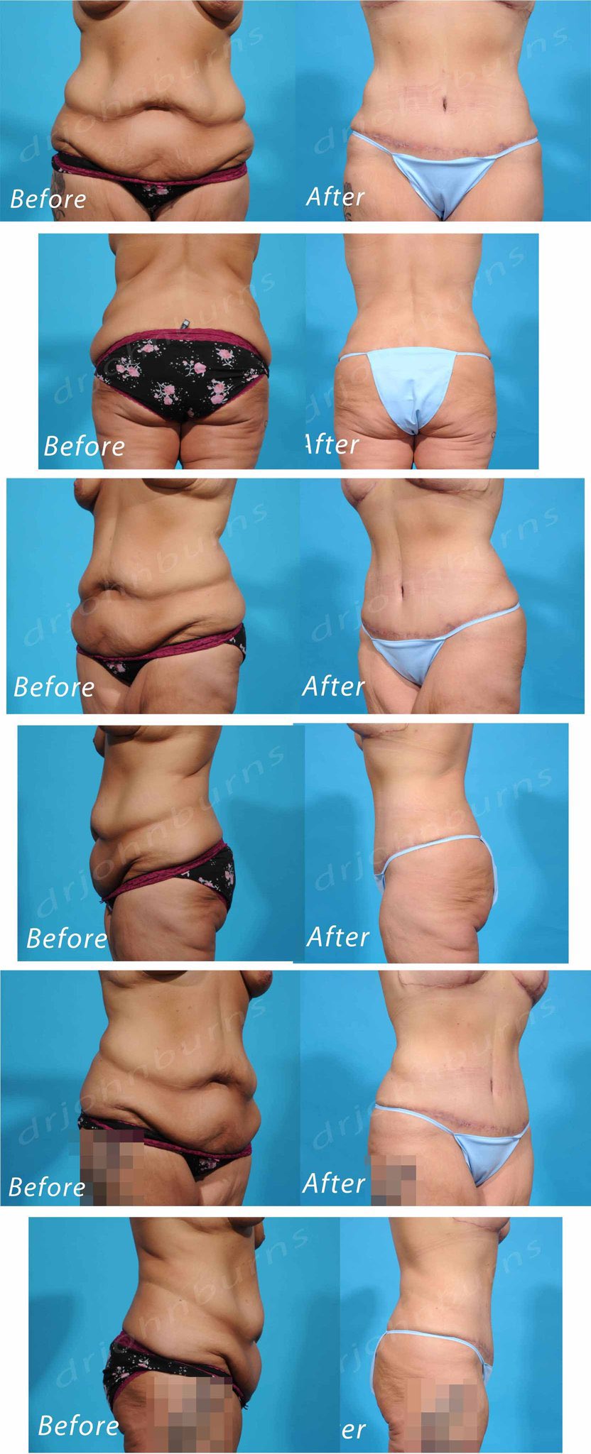 How To Fix Tummy Tuck Dog Ears