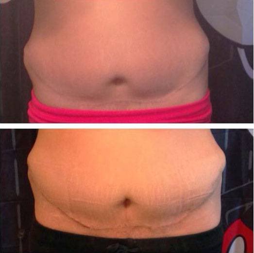 What Are Dog Ears After Tummy Tuck