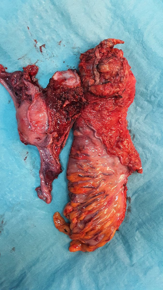 uraiqat's tweet photo. Merging MIS and ERAS gives fabulous results. 86 yo female with T4 rectal cancer invading uterus. Lap. Posterior pelvic exenteration and end colostomy. Hospital stay 3 days. @DaniaNsour @SWexner @ScottRSteeleMD @ManishChandSurg @venky72 @Schadi_CRS https://t.co/NdSW54TTog