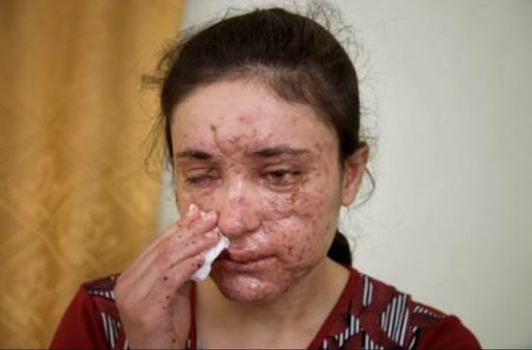 Lamiya, was 15 when ISIS kidnapped her from Kocho, a Yazidi village in  #Sinjar in Aug 2014.She enslaved by the ISIS terrorists for 20 months, sold 5 times in Iraq & Syria. She tried to escape,but in her 5th attempt in Mosul, she was critically injured in a landmine explosion.4/n