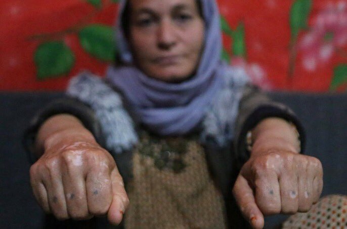 Baseh was 38 when she was enslaved by the Islamic State terrorists. Raped, abused & sold 17 times among members of IS caliphate.One of them, a Swede & another man, an Albanian, stomped on her hands in his military boots, after she scolded him 4 buying a 9-year-old slave girl5/n