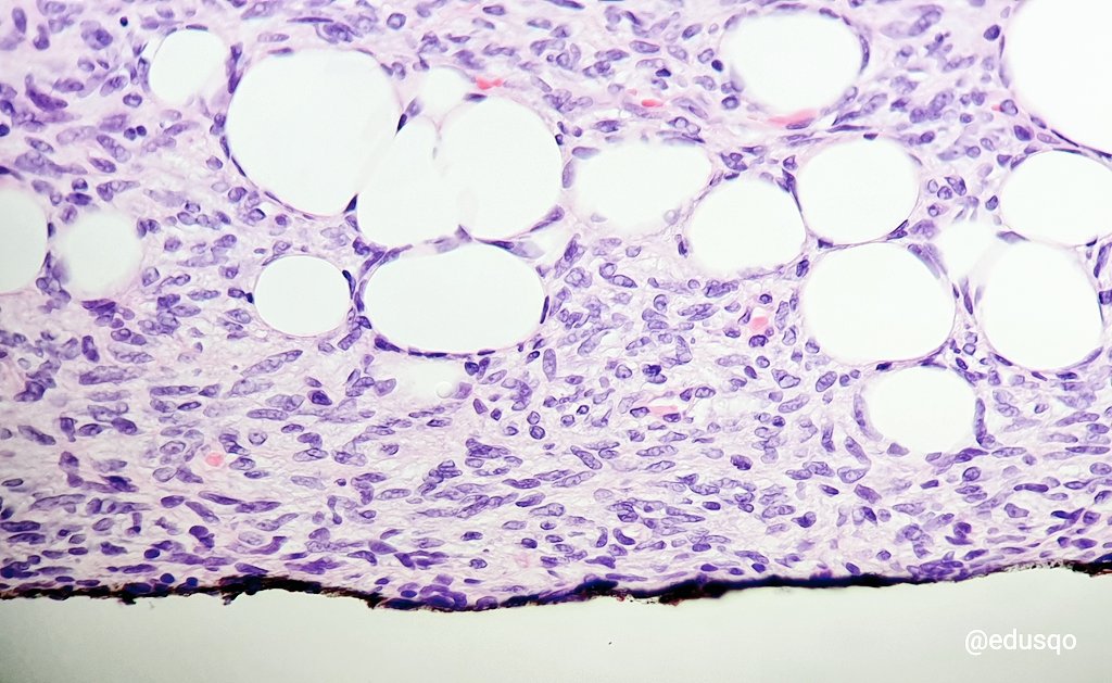 edusqo's tweet photo. 🖌 Why do we ink margins of surgical biopsies? / ¿Por qué teñimos el margen de las biopsias?
🔬 Inked neoplasia under the microscope means +ve margin / Neoplasia teñida significa margen positivo
#Pathology #AnatomíaPatológica #Diagnóstico #SinDiagnósticoNoHayNada
More/Más ⤵️ https://t.co/WhVMoMyoGq
