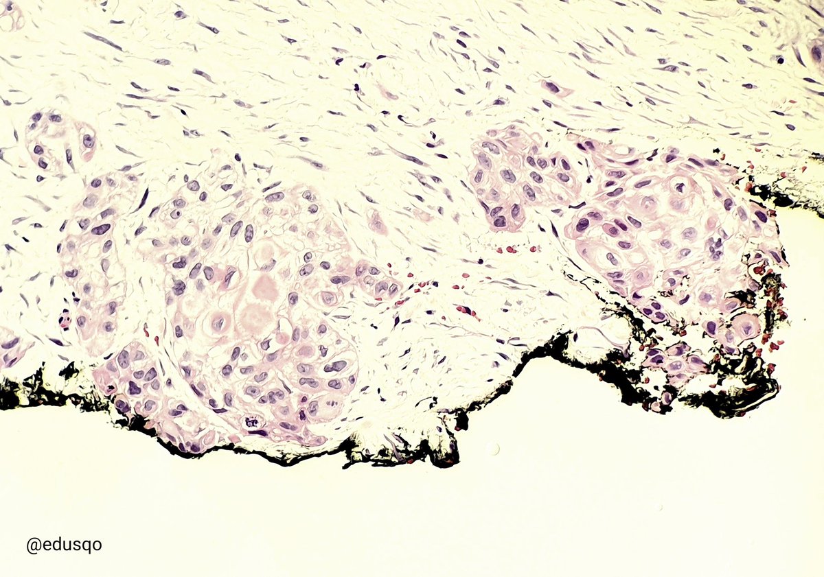 edusqo's tweet photo. 🖌 Why do we ink margins of surgical biopsies? / ¿Por qué teñimos el margen de las biopsias?
🔬 Inked neoplasia under the microscope means +ve margin / Neoplasia teñida significa margen positivo
#Pathology #AnatomíaPatológica #Diagnóstico #SinDiagnósticoNoHayNada
More/Más ⤵️ https://t.co/WhVMoMyoGq