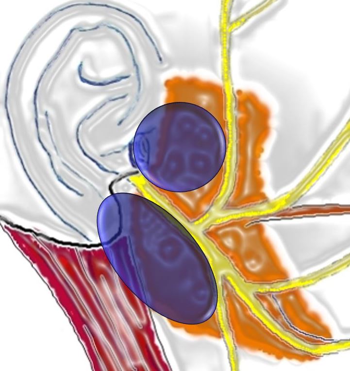 Our review article about benign #Parotid surgery and decision-guide is now online!

An #algorithm with anatomical and other criteria influencing decision making in benign parotid surgery is presented. 

See publication: rdcu.be/b55BO

#parotidsurgery #parotidectomy